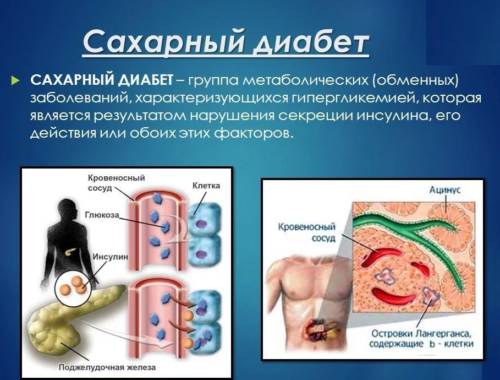 Сахарный диабет - причины, симптомы и лечение